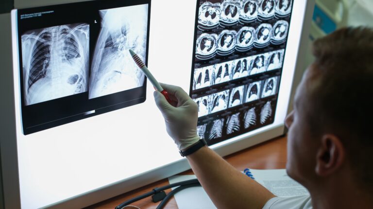 Descubren cuál es la célula que origina el cáncer de pulmón en las personas fumadoras